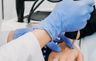 způsoby, jak odstranit bradavice