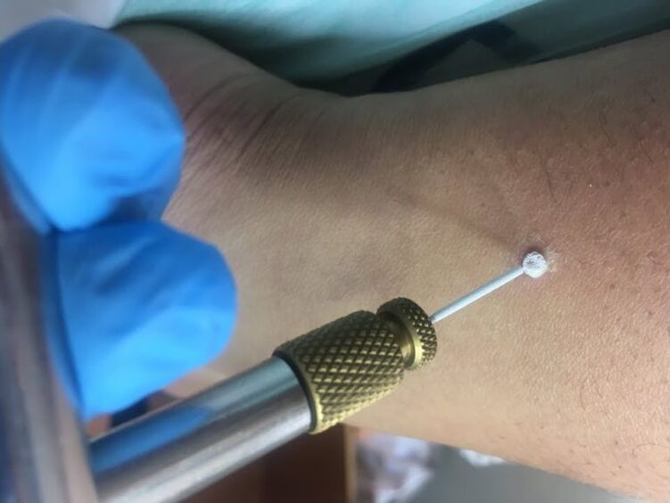 způsoby, jak odstranit bradavice