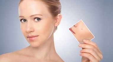 přehled účinných léků na bradavice a papilomy