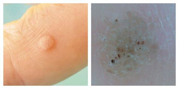 Běžný bradavice během vyšetření a dermatoskopie