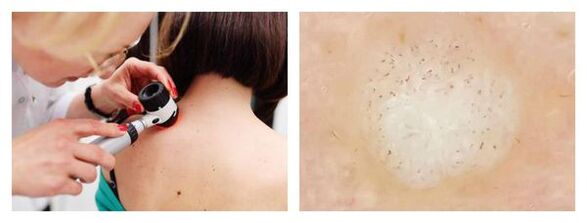 Dermatoskopie bradavice