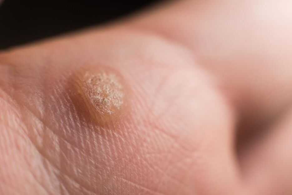 lidský papilomavirus na kůži